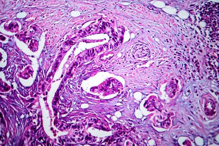 Breast cancer, light micrograph, photo under microscopeの写真素材