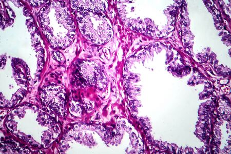 Prostate cancer, light micrograph, photo under microscopeの写真素材