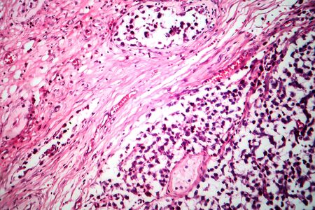 Testicular seminoma, light micrograph, photo under microscope. A most common germ cell tumor of the...