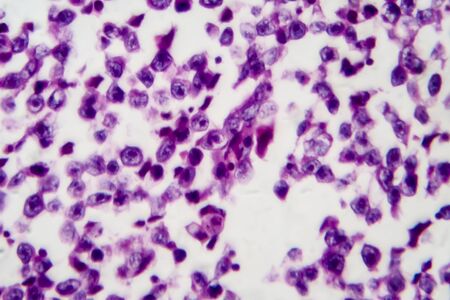 Testicular seminoma, light micrograph, photo under microscope. A most common germ cell tumor of the testisの写真素材