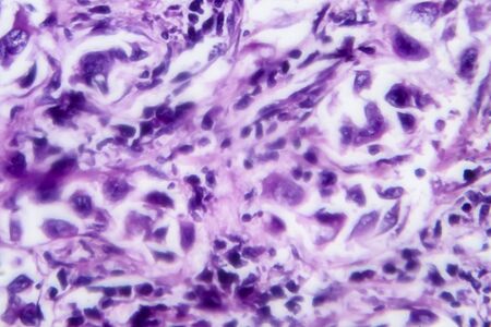Breast ductal carcinoma, light micrograph, photo under microscope