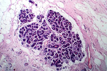Breast cancer, light micrograph, photo under microscopeの写真素材