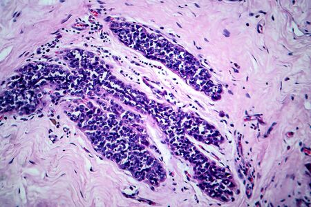 Breast cancer, light micrograph, photo under microscopeの写真素材