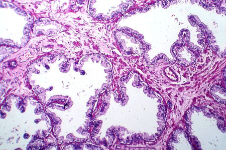 Prostate cancer, light micrograph, photo under microscopeの写真素材