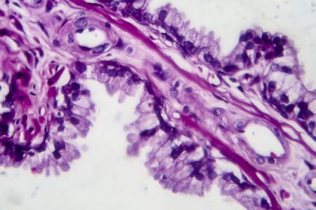 Prostate cancer, light micrograph, photo under microscopeの写真素材