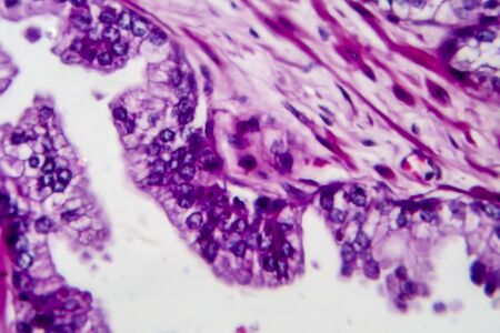 Prostate cancer, light micrograph, photo under microscopeの写真素材