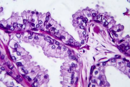 Prostate cancer, light micrograph, photo under microscopeの写真素材