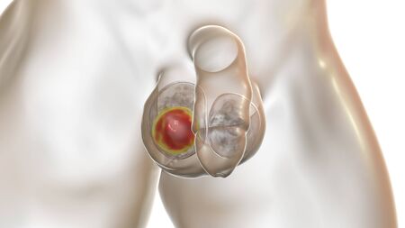 Testicular seminoma, 3D illustration. A most common germ cell tumor of the testis