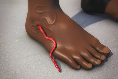 Guinea worm disease, dracunculiasis, 3D illustration. A disease caused by nematode roundworm...
