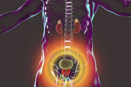 Benign prostatic hyperplasia, 3D illustration showing enlarged prostate gland