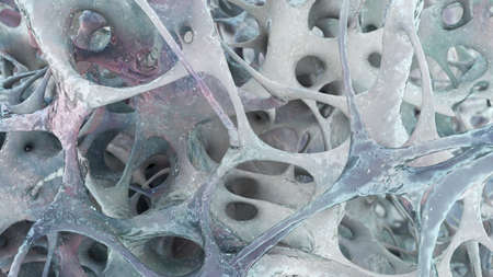 Osteoporotic trabecular bone, 3D illustration showing fewer and thinner trabeculae in bone with...