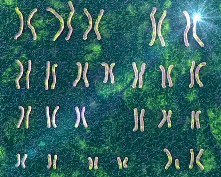 Karyotype of Cri du chat, or cats cry, syndrome, also known as 5p- syndrome