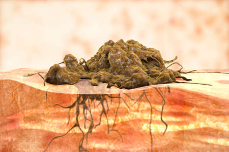 Invasive cancer growth, 3D illustration showing tumor invasion into underlined tissueの写真素材
