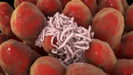 Parasitic worms in intestine