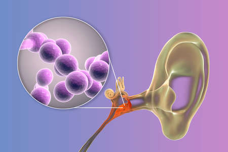 Chronic suppurative otitis media caused by fungi Candida, inflammatory disease of the middle ear, 3D...