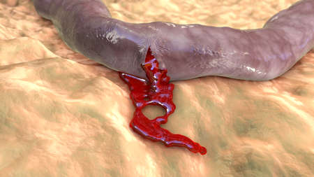 Hemorrhage, blood flowing from the damaged blood vessel, 3D illustration. Hemorrhagic stroke,...