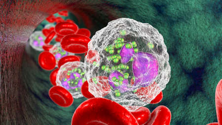 Meningococcemia, bacteria Neisseria meningitidis in the bloodstream inside neutrophils