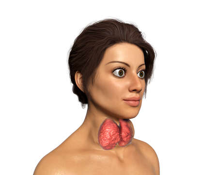 Hyperthyroidism. 3D illustration showing enlarged thyroid gland and exophthalmos (bulging eyes) in a...