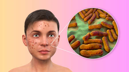 Acne vulgaris in a teenager boy and closeup view of bacteria Cutibacterium acnes, formely formerly...