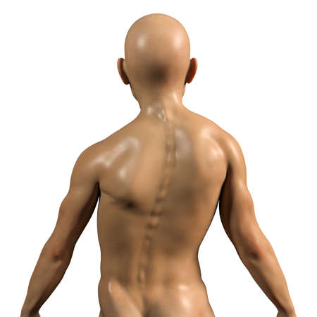 A boy with scoliosis, 3D illustration. Spine curve anatomy
