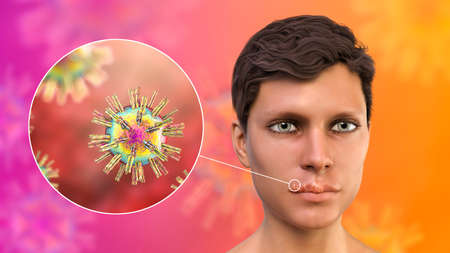 Herpes labialis, also known as cold sores, 3D illustration showing lesions on the man's lips caused by herpes simplex virus and closeup view of the virusの写真素材