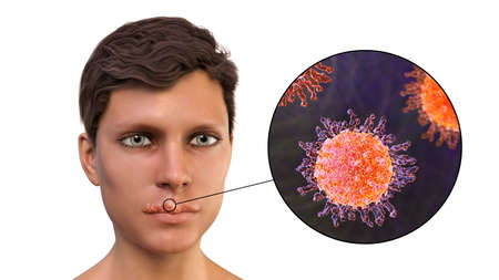 Herpes labialis, also known as cold sores, 3D illustration showing lesions on the man's lips caused by herpes simplex virus and closeup view of the virusの写真素材