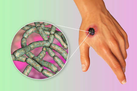 Cutaneous anthrax, the most common form of anthrax. 3D illustration showing the characteristic black...