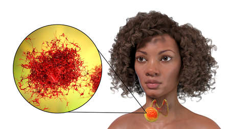 Thyroid cancer, 3D illustration showing tumor inside thyroid gland and closeup view of cancer cells