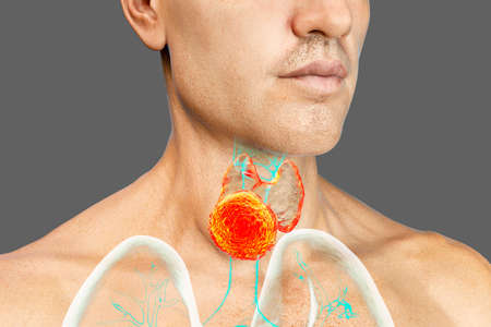 Thyroid cancer, tumor inside thyroid gland