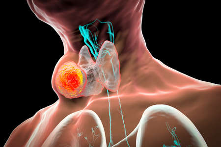 Thyroid cancer, 3D illustration showing tumor inside thyroid glandの写真素材