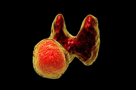 Thyroid cancer, 3D illustration showing tumor inside thyroid glandの写真素材