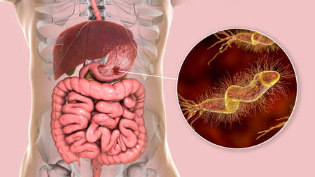 Stomach ulcer and closeup view of bacteria Helicobacter pylori, associated with ulcer formation, 3D...