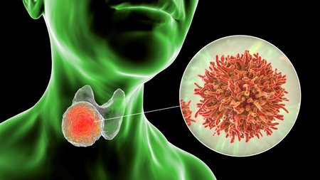 Thyroid cancer, 3D illustration showing tumor inside thyroid gland and closeup view of cancer cells