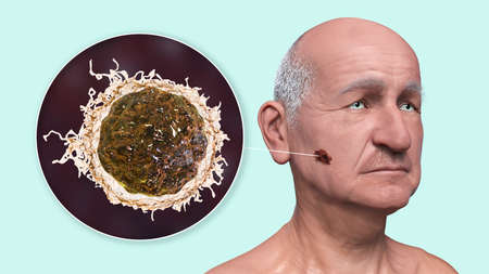 Melanoma, a cancer developing from pigment-containing cells melanocytes, 3D illustration showing...