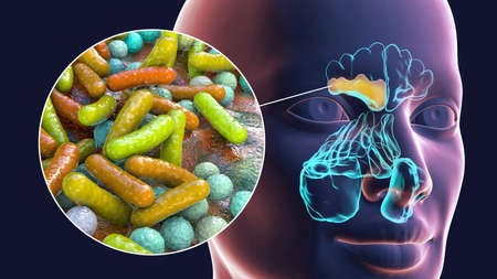 Sinusitis, inflammation of paranasal cavities. 3D illustration showing purulent inflammation of...