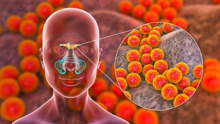Sinusitis, inflammation of paranasal cavities. 3D illustration showing purulent inflammation of...