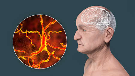 Dementia, conceptual 3D illustration showing an elderly person with progressive impairments of brain...