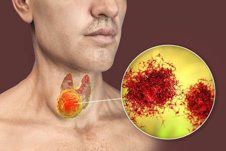 Thyroid cancer, 3D illustration showing tumor inside thyroid gland and closeup view of cancer cells
