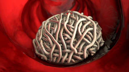 Parasitic worms in the lumen of intestine, 3D illustration. Growth and multiplication of nematode...