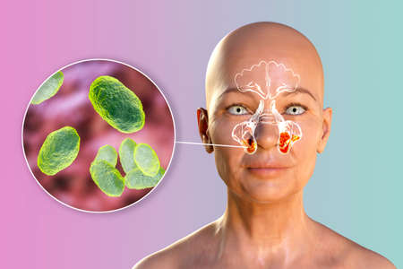 Haemophilus influenzae bacteria as a cause of sinusitis. 3D illustration showing inflammation of...