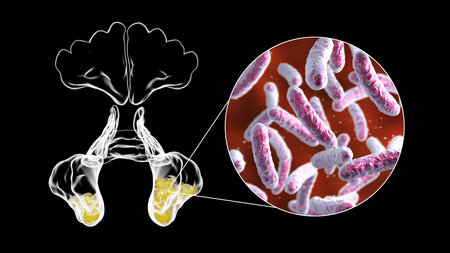 Sinusitis, inflammation of paranasal cavities. 3D illustration showing inflammation of maxillary...