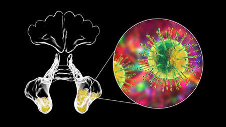 Viral sinusitis, inflammation of paranasal cavities. 3D illustration showing inflammation of...