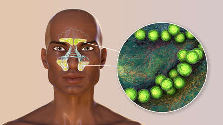 Streptococcus pyogenes bacteria and other streptococci as a cause of sinusitis. 3D illustration...