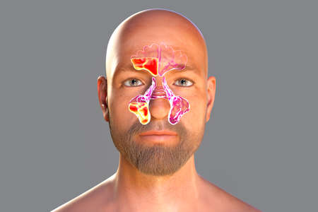 Sinusitis, inflammation of paranasal cavities. 3D illustration showing purulent inflammation of frontal and maxillary sinuses in a manの写真素材