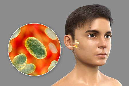 Haemophilus influenzae bacterium as a cause of otitis media. 3D illustration showing purulent inflammation of the middle ear in a boy and close-up view of Haemophilus bacteriaの写真素材