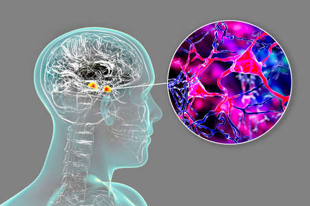 Amygdala in the brain, and closeup view of amygdala neurons, 3D illustration. Two almond-shaped...