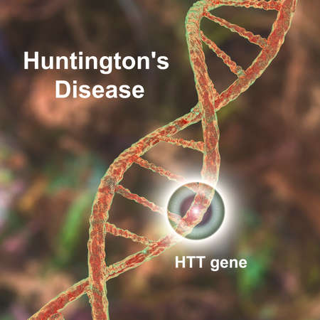 Huntington's disease, also known as Huntington's chorea, a neurodegenerative disease due to a mutation in the huntingtin gene, HTT, conceptual 3D illustrationの写真素材