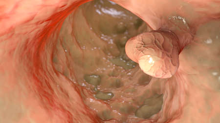 Bowel polyps, colorectal polyps, 3D illustration showing numerous polypous protrusions on the on the...