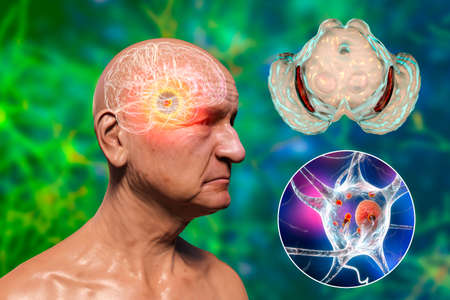 An old man with Parkinson's disease and highlighted black substance of the midbrain. 3D illustration...
