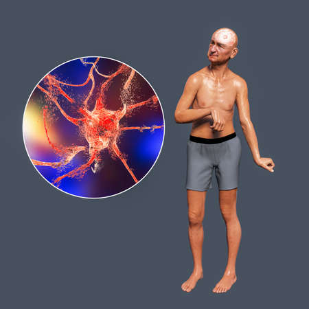 A person with chorea disease and close-up view of neuronal degradation which results of choreiform movements, conceptual 3D illustrationの写真素材